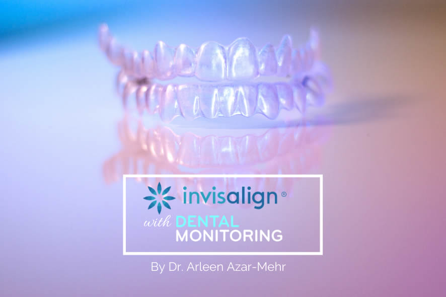 INTRODUCING DENTAL MONITORING WITH DR. ARLEEN AZAR-MEHR! Faster, More Efficient Invisalign Treatment with Fewer Appointments
