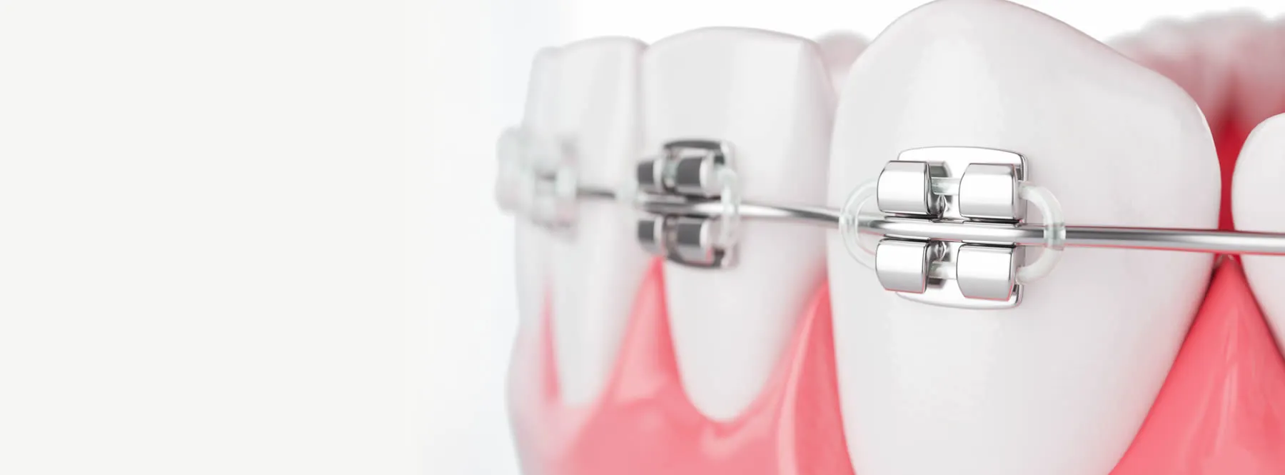 A 3D render of braces on a set of teeth