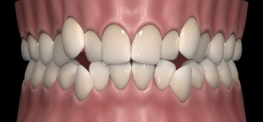 3D realistic rendering of teeth crowding