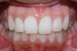 dental crowns after